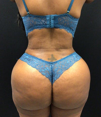 Brazilian Butt Lift Before & After Gallery - Patient 58244184 - Image 2