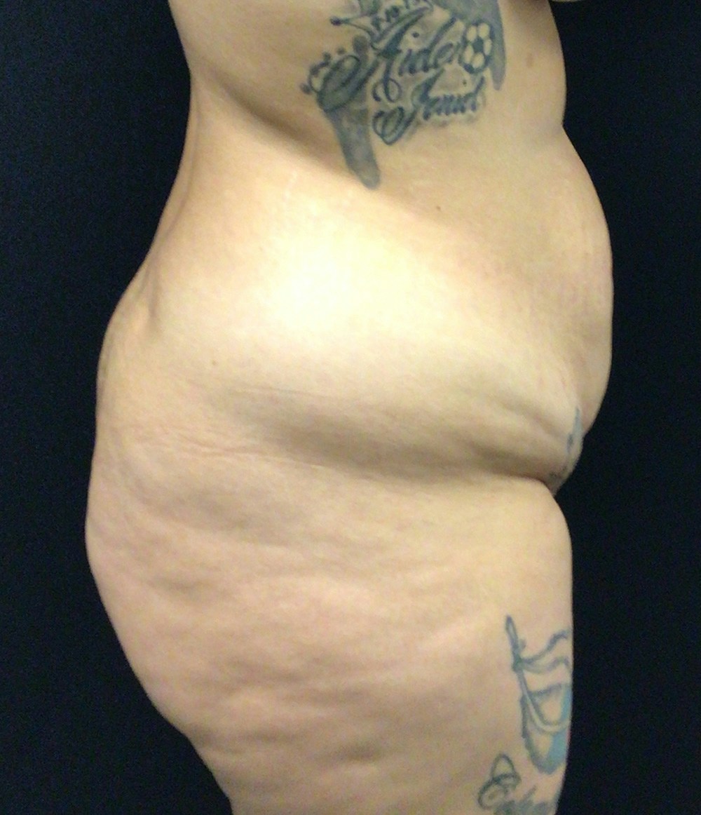 Brazilian Butt Lift Before & After Gallery - Patient 58243818 - Image 5