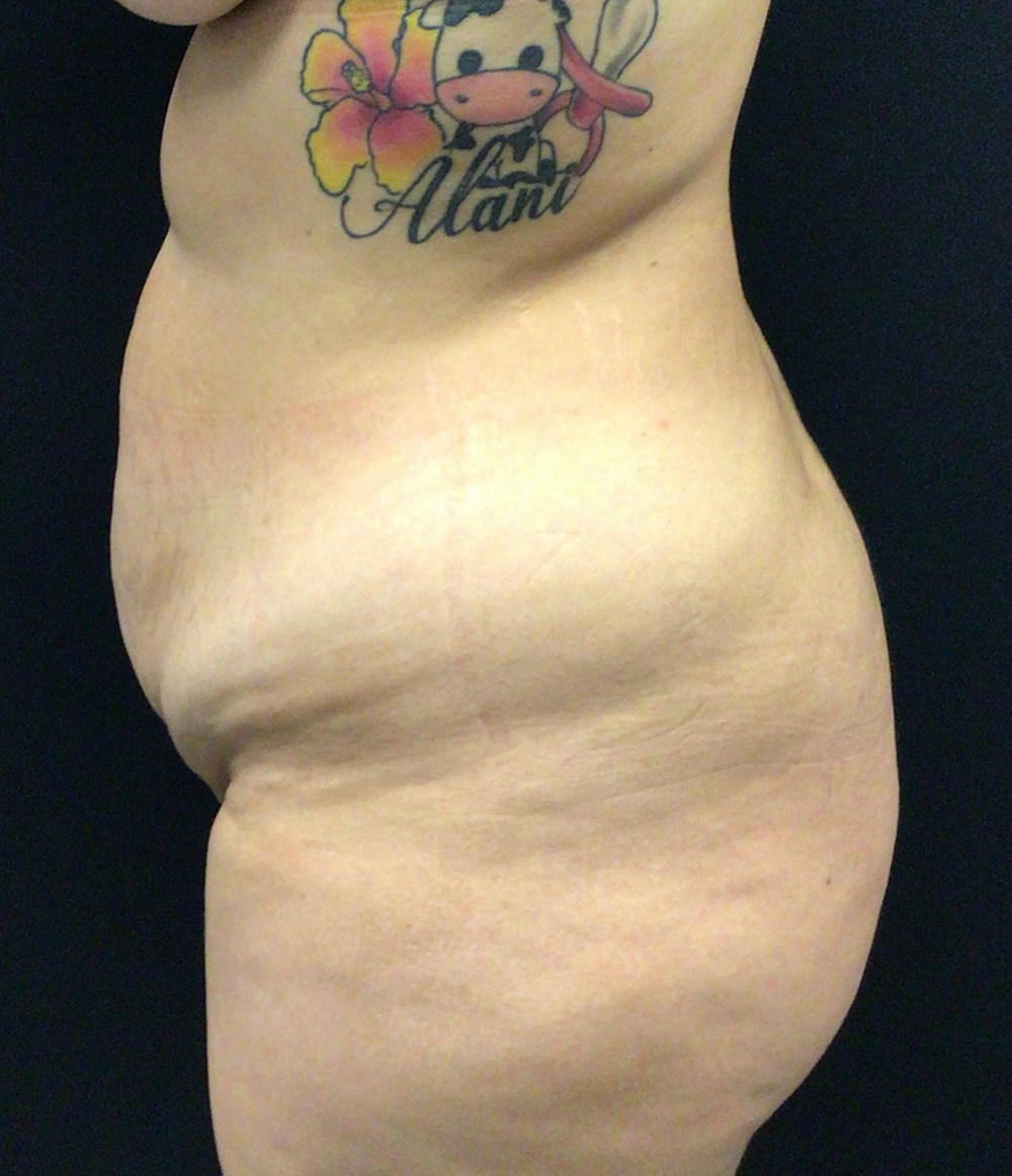 Brazilian Butt Lift Before & After Gallery - Patient 58243818 - Image 7