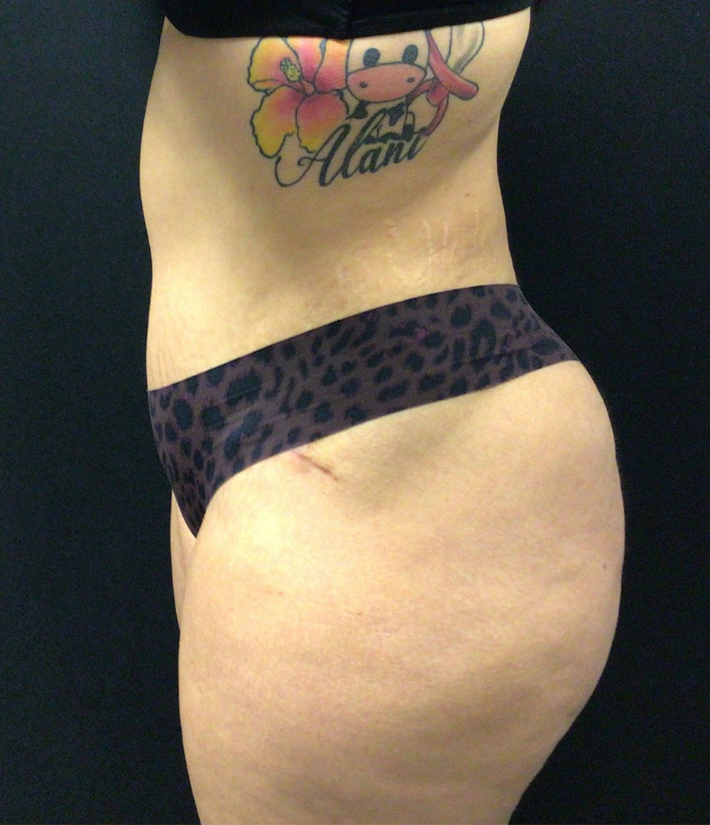 Brazilian Butt Lift Before & After Gallery - Patient 58243818 - Image 8