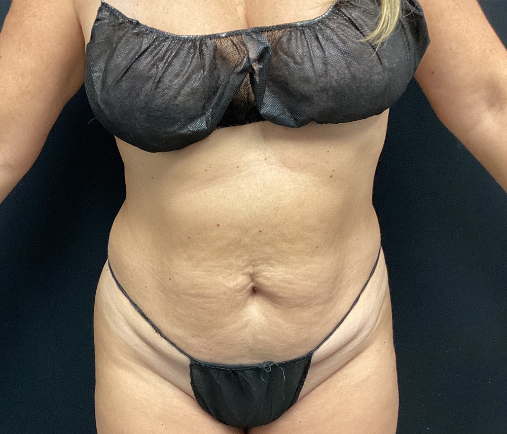 Liposuction Before & After Gallery - Patient 91440340 - Image 1