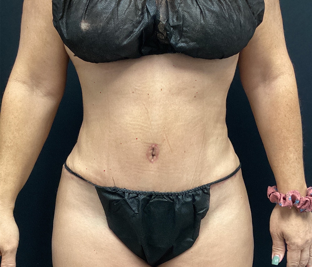 Liposuction Before & After Gallery - Patient 91440340 - Image 2