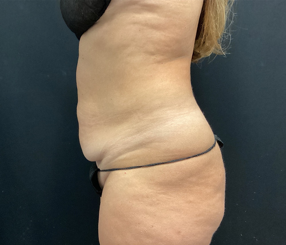 Liposuction Before & After Gallery - Patient 91440340 - Image 5