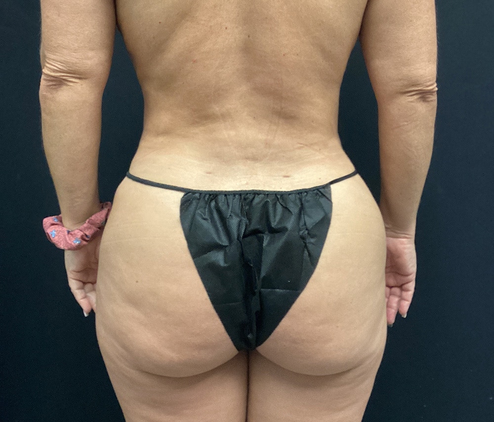 Liposuction Before & After Gallery - Patient 91440340 - Image 8