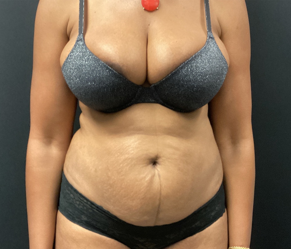 Liposuction Before & After Gallery - Patient 91440339 - Image 1
