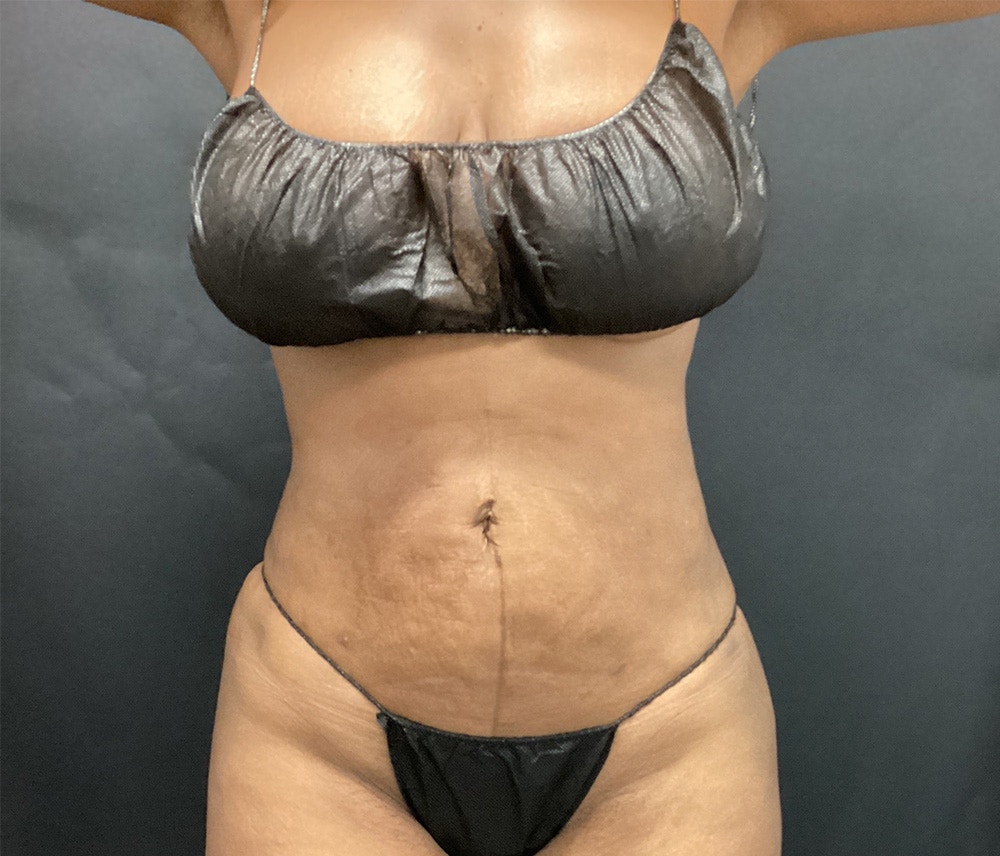 Liposuction Before & After Gallery - Patient 91440339 - Image 2