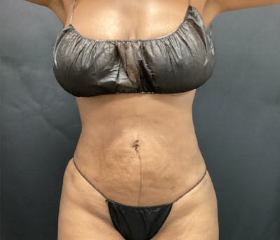 Liposuction Before & After Gallery - Patient 91440339 - Image 2