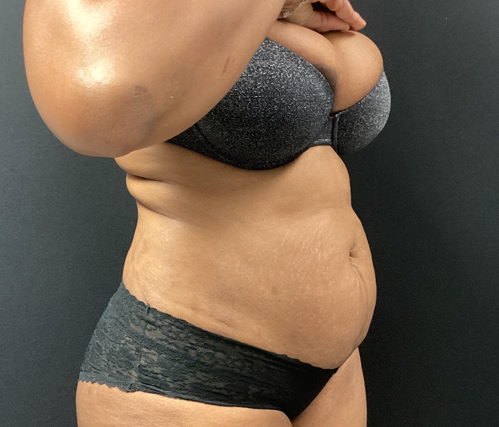 Liposuction Before & After Gallery - Patient 91440339 - Image 3