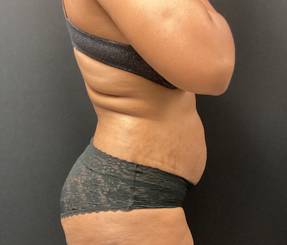 Lipo 360 Before & After Gallery - Patient 91440339 - Image 5
