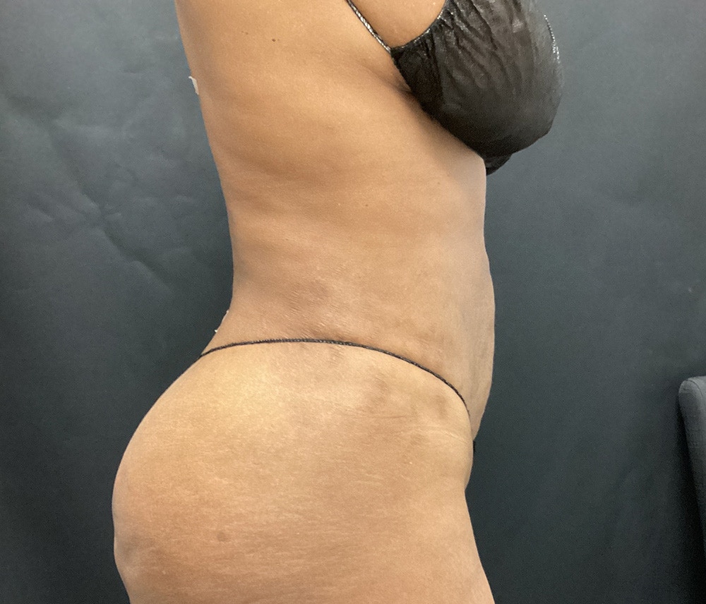 Liposuction Before & After Gallery - Patient 91440339 - Image 6
