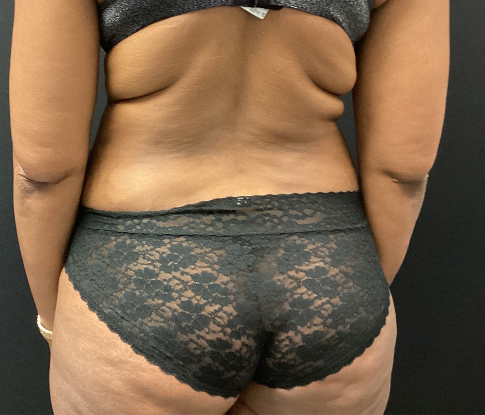 Liposuction Before & After Gallery - Patient 91440339 - Image 7