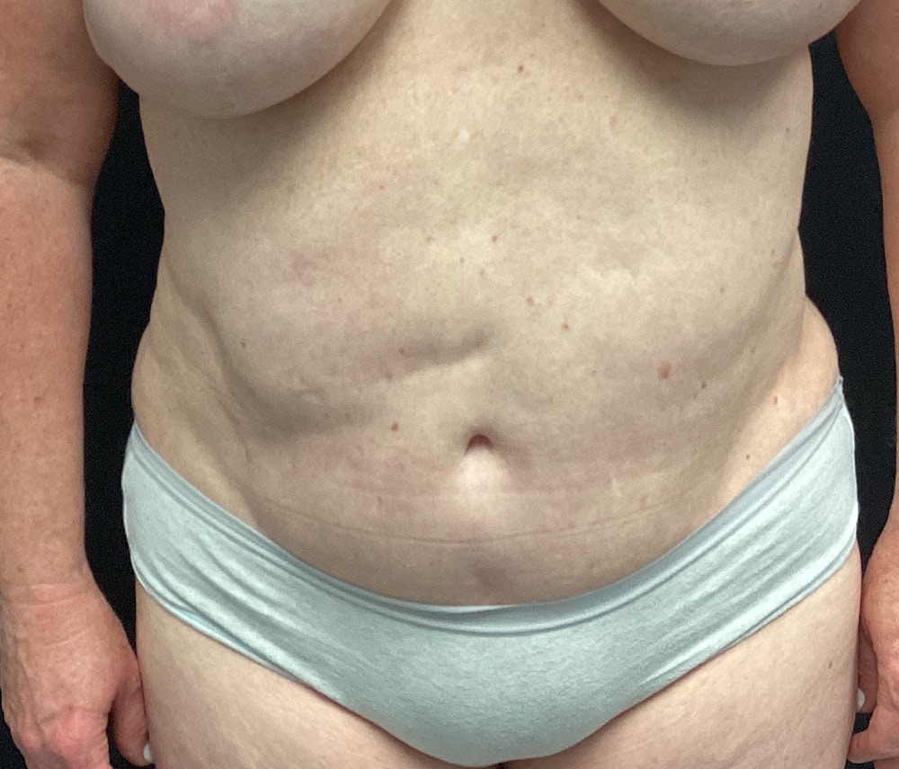 Liposuction Before & After Gallery - Patient 91440360 - Image 1