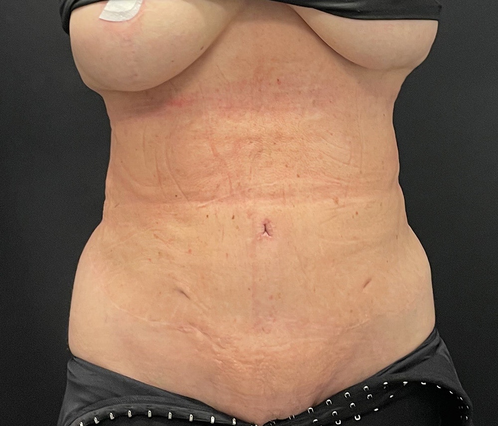 Liposuction Before & After Gallery - Patient 91440360 - Image 2