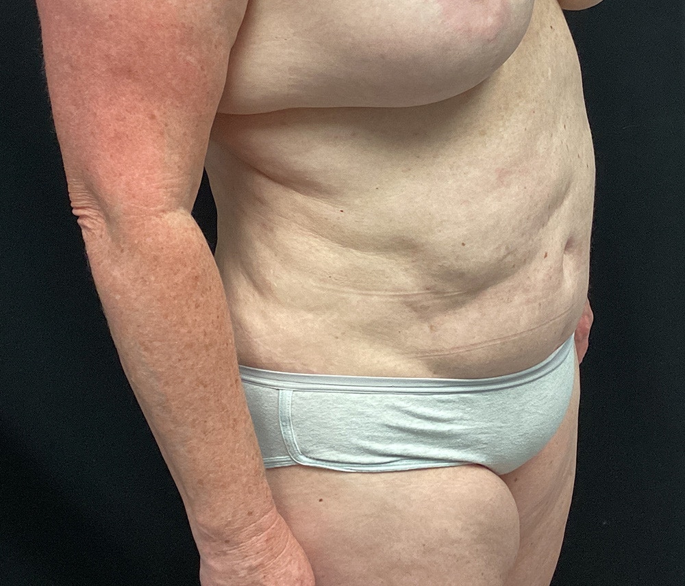Liposuction Before & After Gallery - Patient 91440360 - Image 3