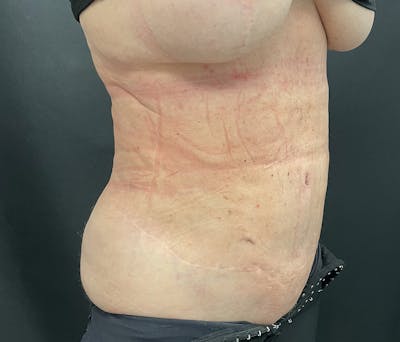 Liposuction Before & After Gallery - Patient 91440360 - Image 4