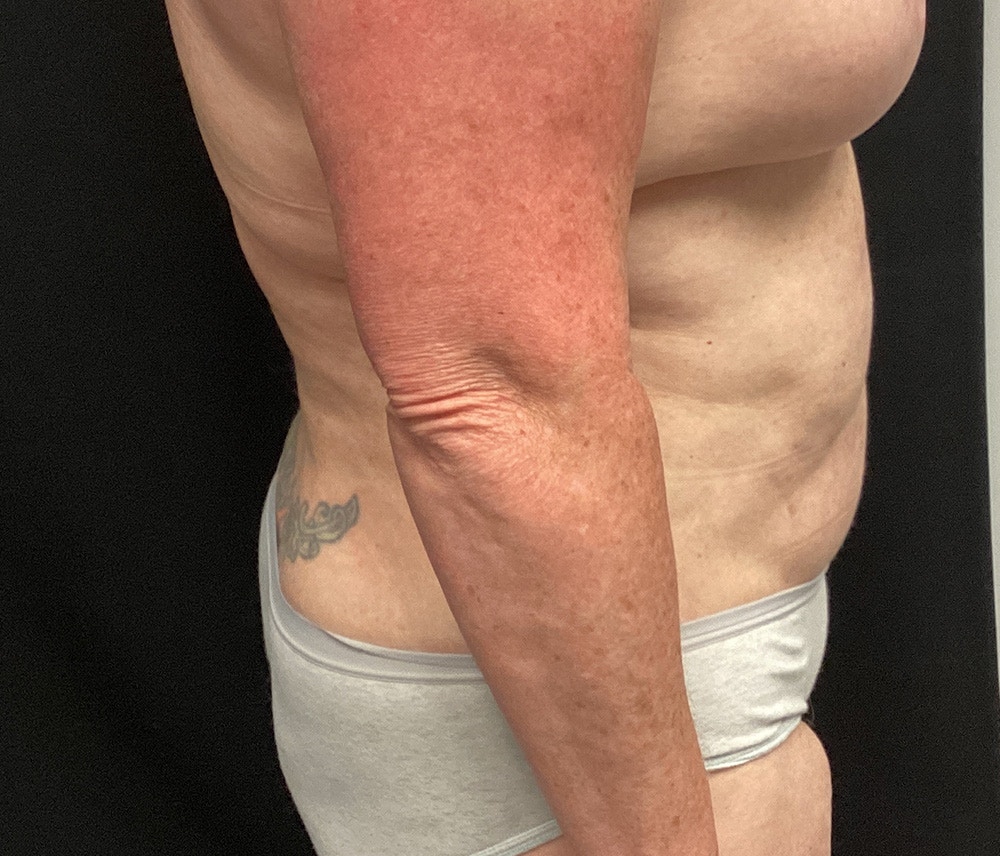 Liposuction Before & After Gallery - Patient 91440360 - Image 5