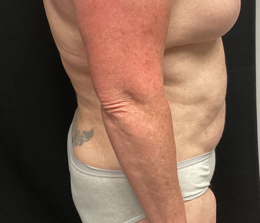 Lipo 360 Before & After Gallery - Patient 91440360 - Image 5
