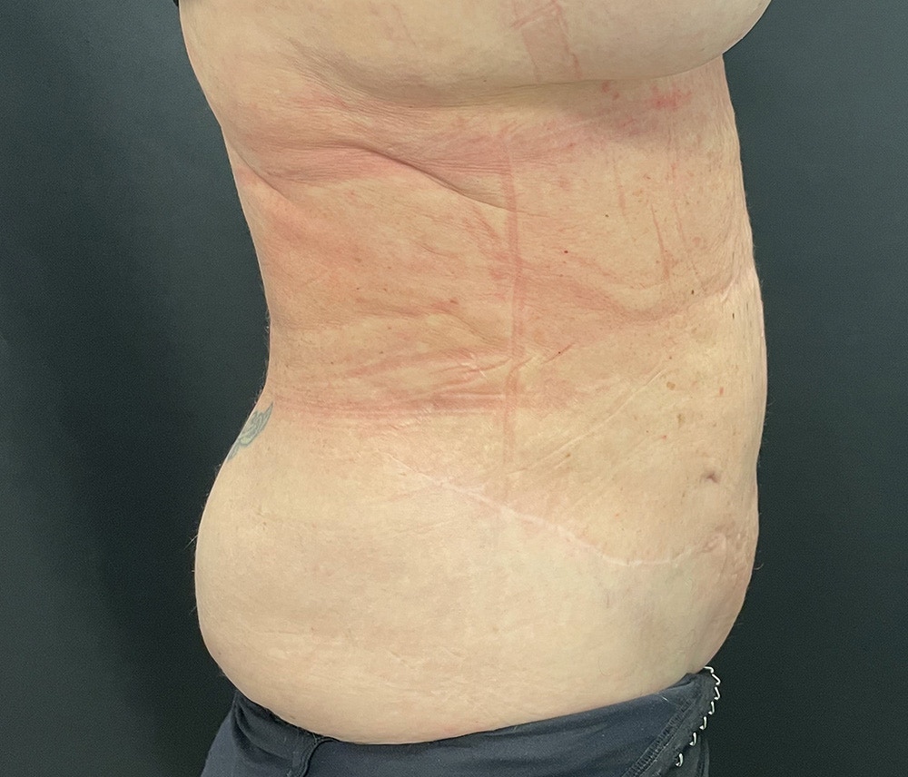 Liposuction Before & After Gallery - Patient 91440360 - Image 6