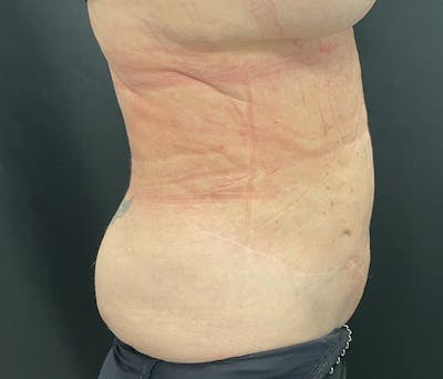 Liposuction Before & After Gallery - Patient 91440360 - Image 6