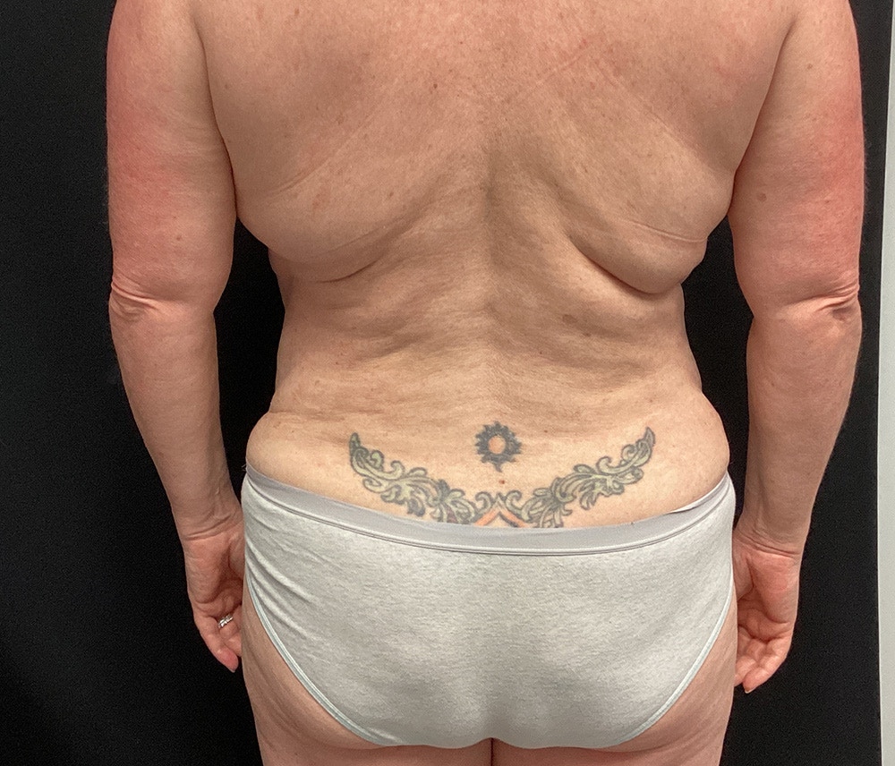 Liposuction Before & After Gallery - Patient 91440360 - Image 7