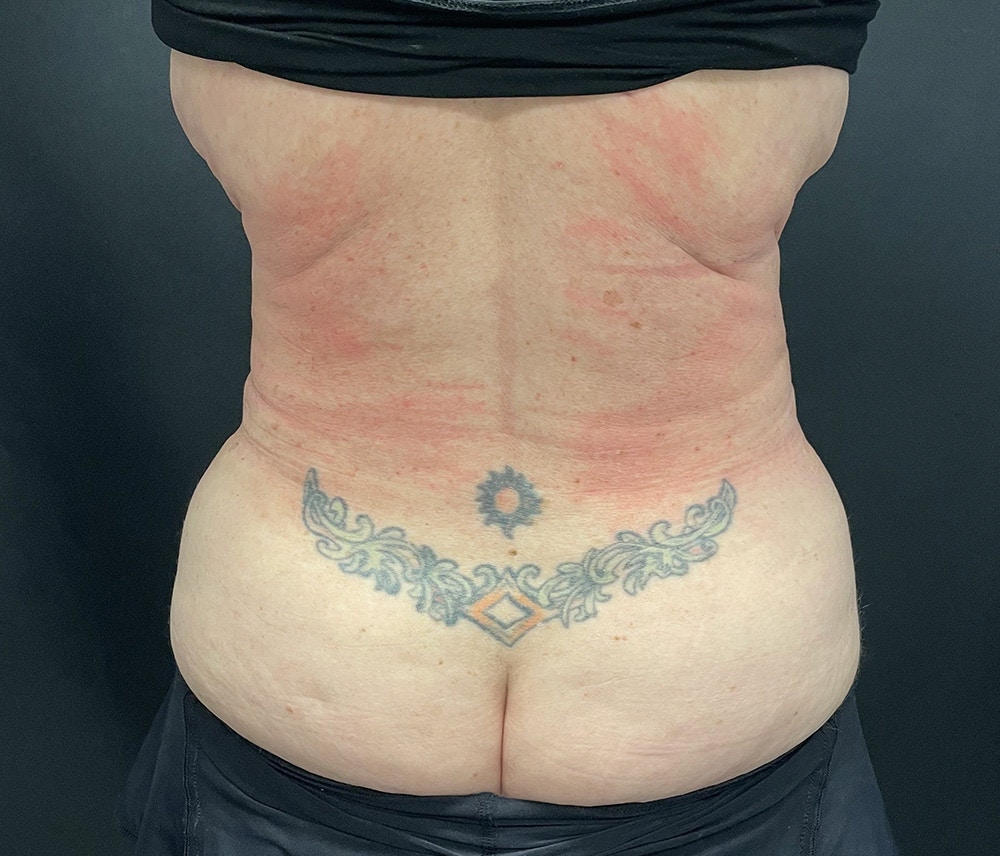 Liposuction Before & After Gallery - Patient 91440360 - Image 8