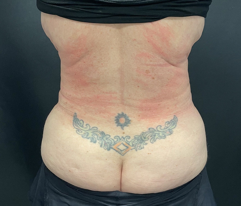Lipo 360 Before & After Gallery - Patient 91440360 - Image 8
