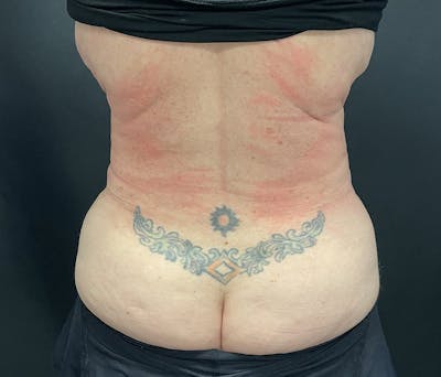 Liposuction Before & After Gallery - Patient 91440360 - Image 8