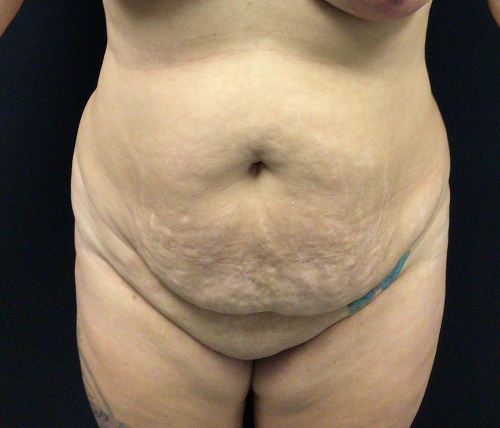 Lipo 360 Before & After Gallery - Patient 91440386 - Image 1