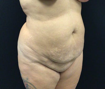 Liposuction Before & After Gallery - Patient 91440386 - Image 3