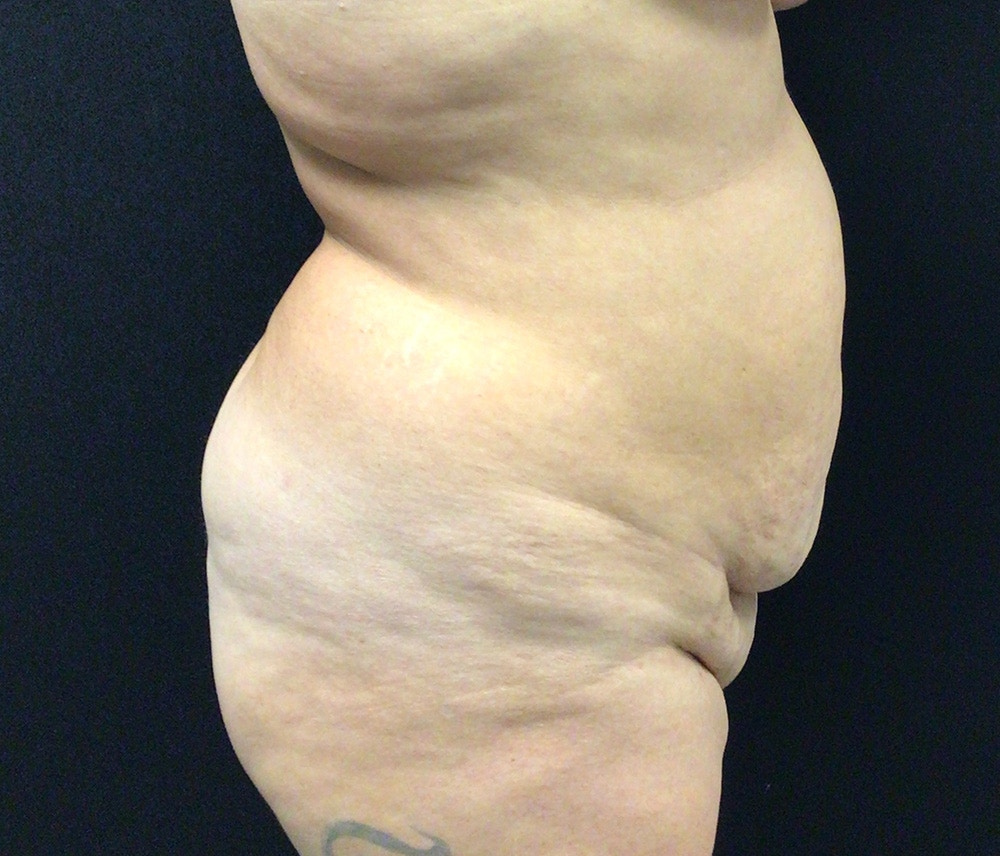 Liposuction Before & After Gallery - Patient 91440386 - Image 5