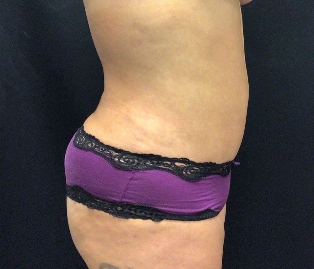 Lipo 360 Before & After Gallery - Patient 91440386 - Image 6