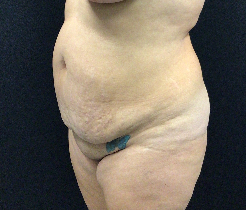 Liposuction Before & After Gallery - Patient 91440386 - Image 7
