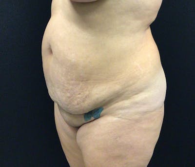 Liposuction Before & After Gallery - Patient 91440386 - Image 7