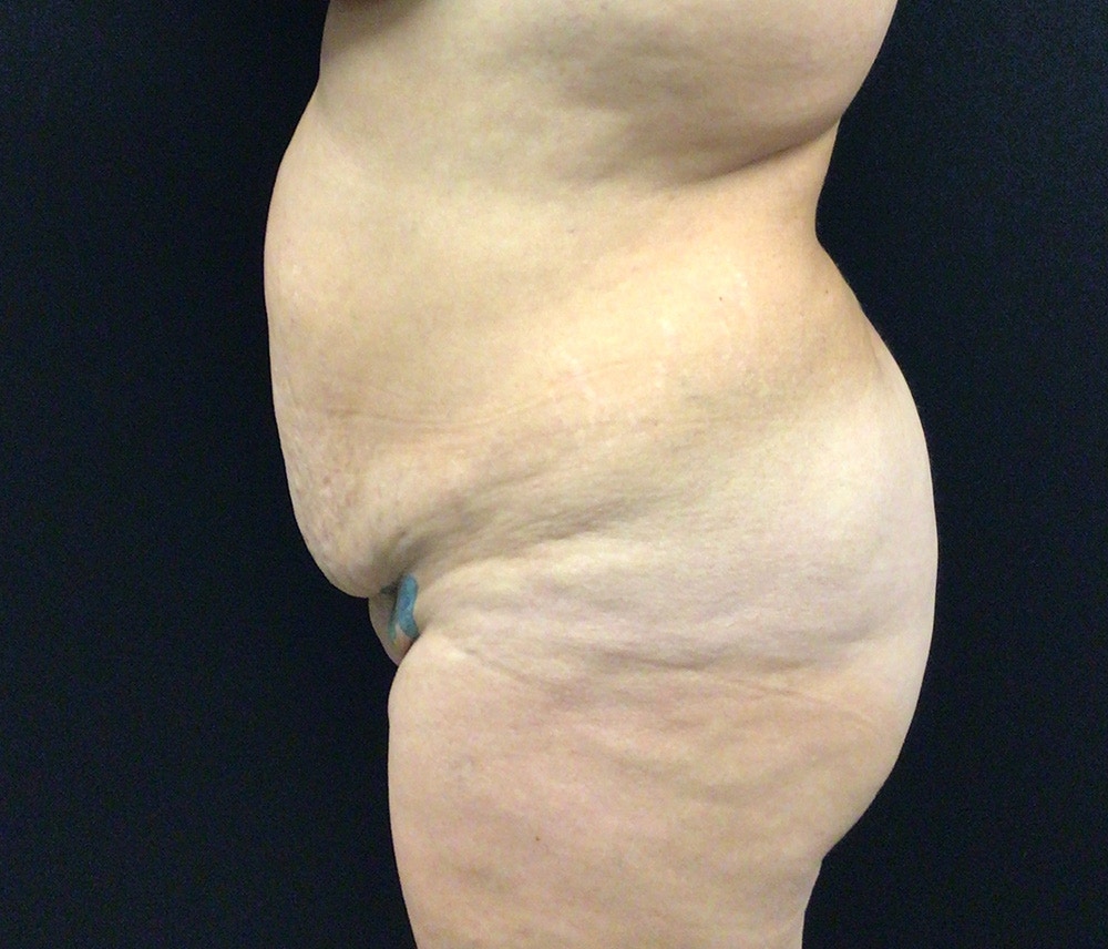 Liposuction Before & After Gallery - Patient 91440386 - Image 9