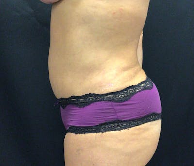 Liposuction Before & After Gallery - Patient 91440386 - Image 10