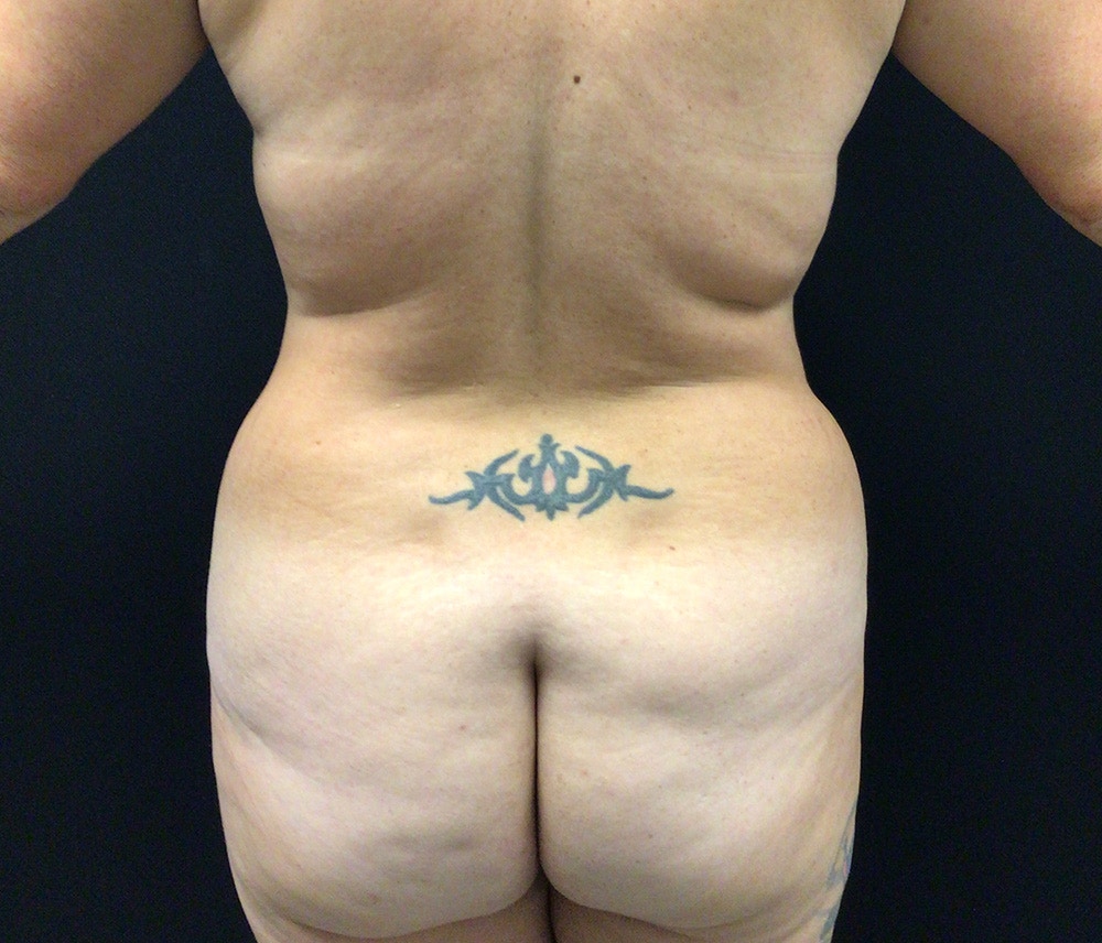 Liposuction Before & After Gallery - Patient 91440386 - Image 11