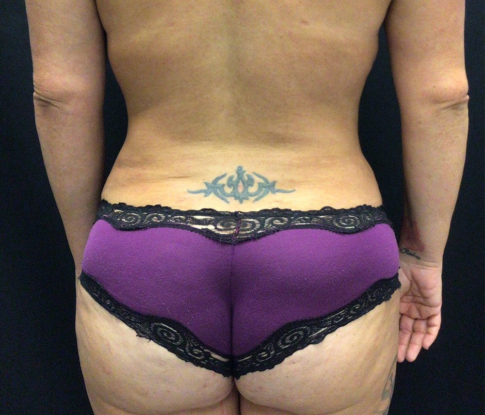 Liposuction Before & After Gallery - Patient 91440386 - Image 12