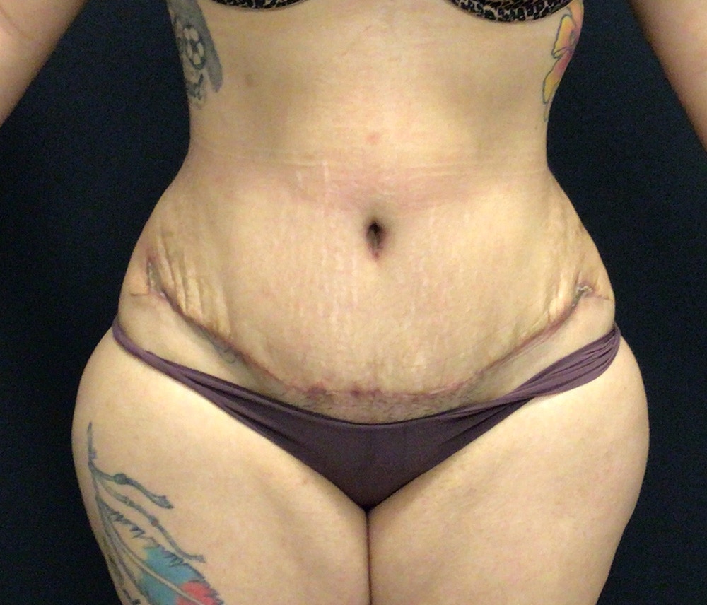 Liposuction Before & After Gallery - Patient 91440422 - Image 2