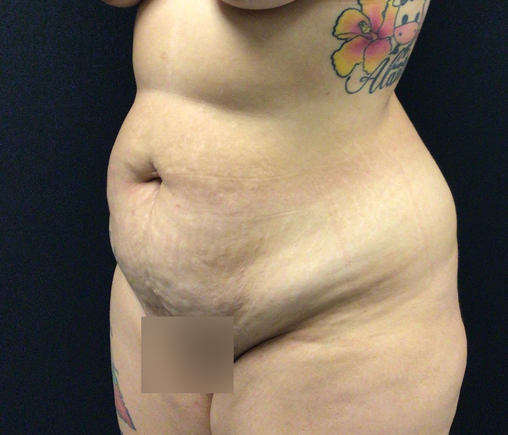 Liposuction Before & After Gallery - Patient 91440422 - Image 3