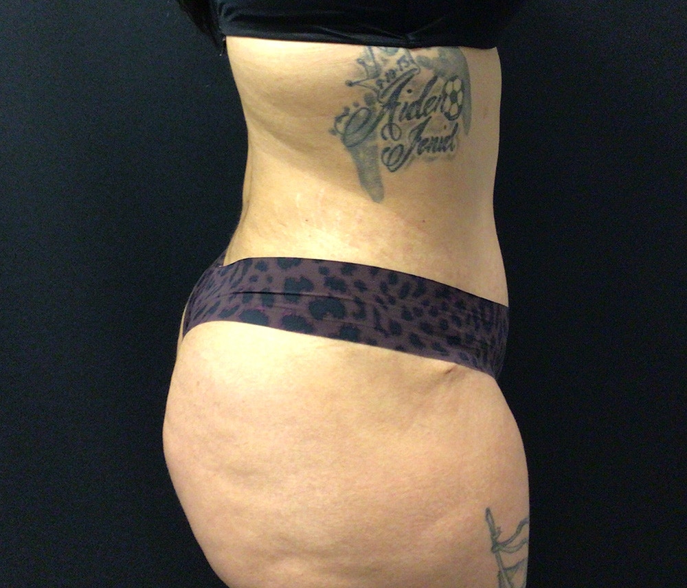 Lipo 360 Before & After Gallery - Patient 91440422 - Image 6