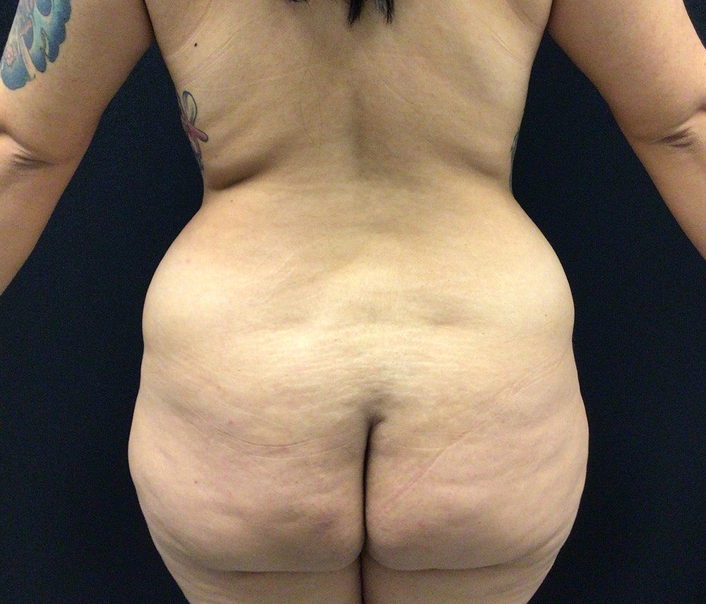 Liposuction Before & After Gallery - Patient 91440422 - Image 7