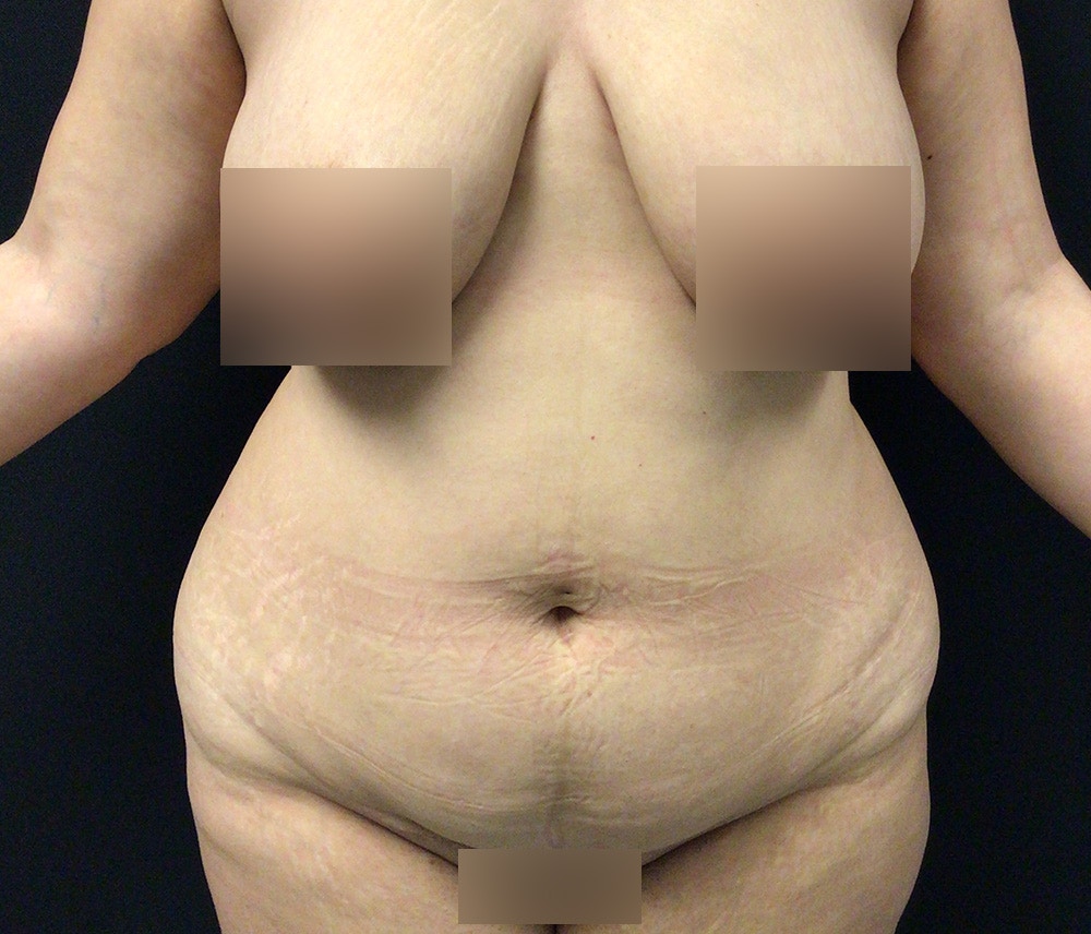 Liposuction Before & After Gallery - Patient 91440443 - Image 1