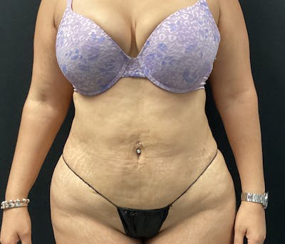 Liposuction Before & After Gallery - Patient 91440443 - Image 2