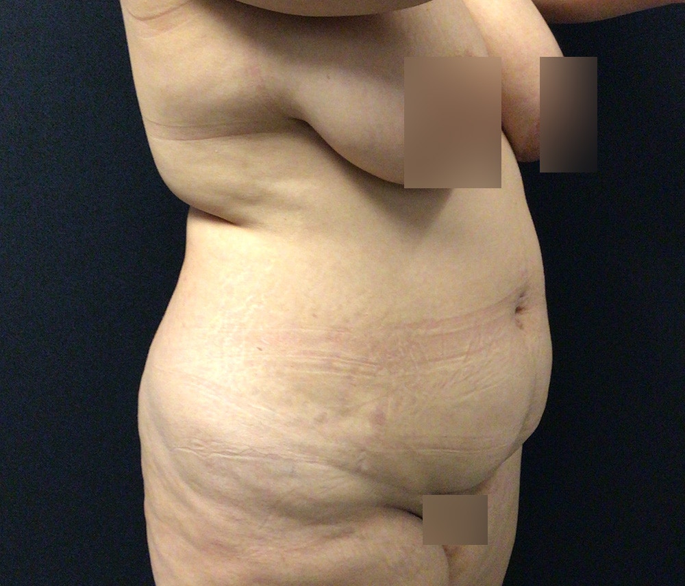 Lipo 360 Before & After Gallery - Patient 91440443 - Image 3