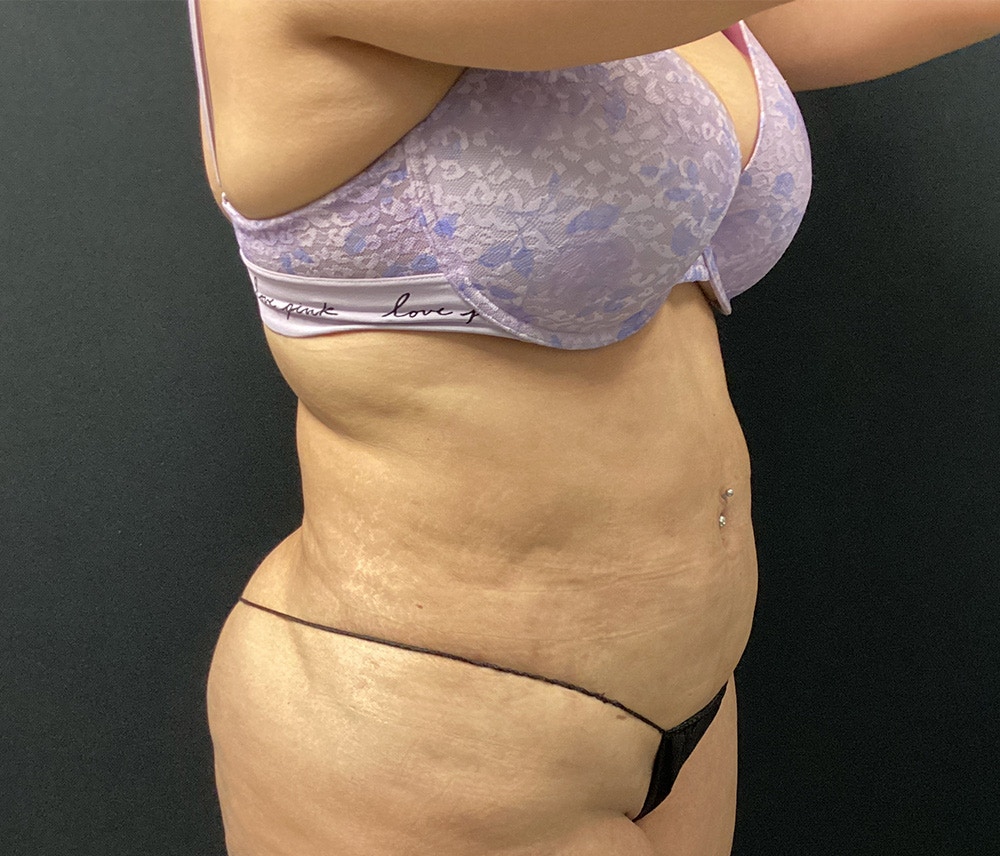 Lipo 360 Before & After Gallery - Patient 91440443 - Image 4