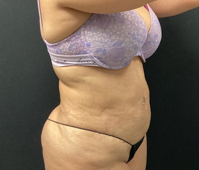 Liposuction Before & After Gallery - Patient 91440443 - Image 4