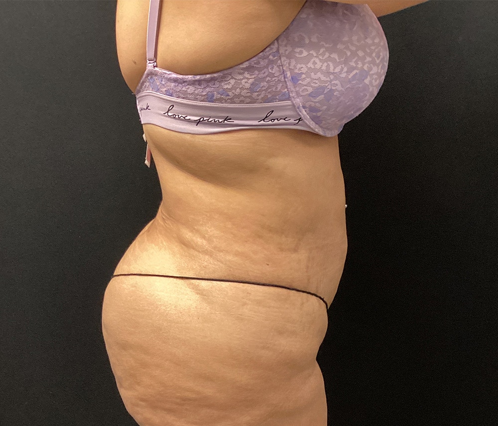 Liposuction Before & After Gallery - Patient 91440443 - Image 6