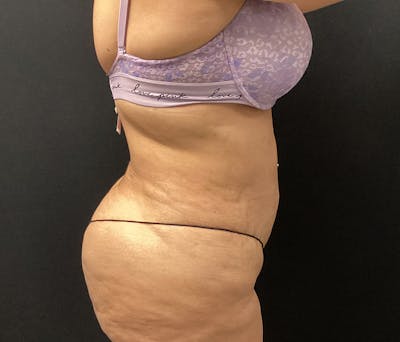 Liposuction Before & After Gallery - Patient 91440443 - Image 6