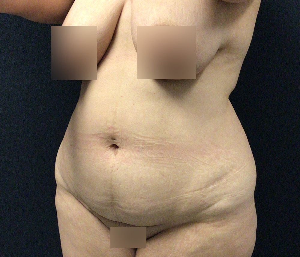 Lipo 360 Before & After Gallery - Patient 91440443 - Image 7