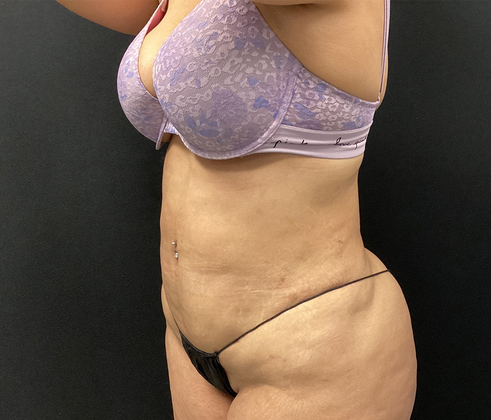 Lipo 360 Before & After Gallery - Patient 91440443 - Image 8